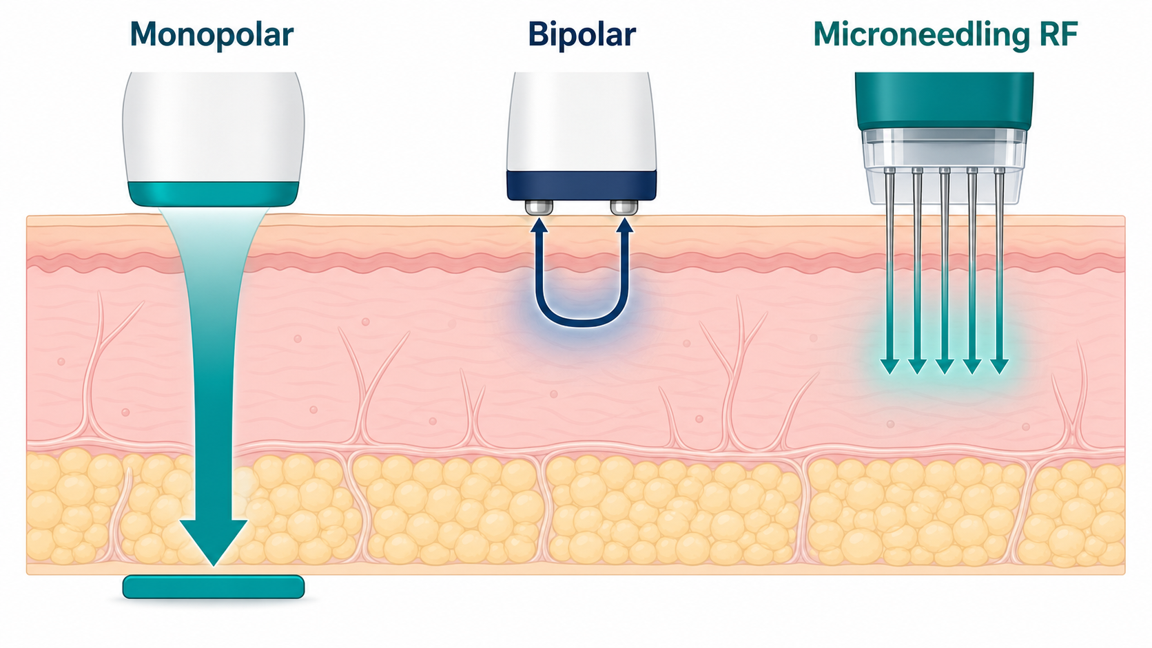 Comparison of monopolar RF, bipolar RF, and RF microneedling depth