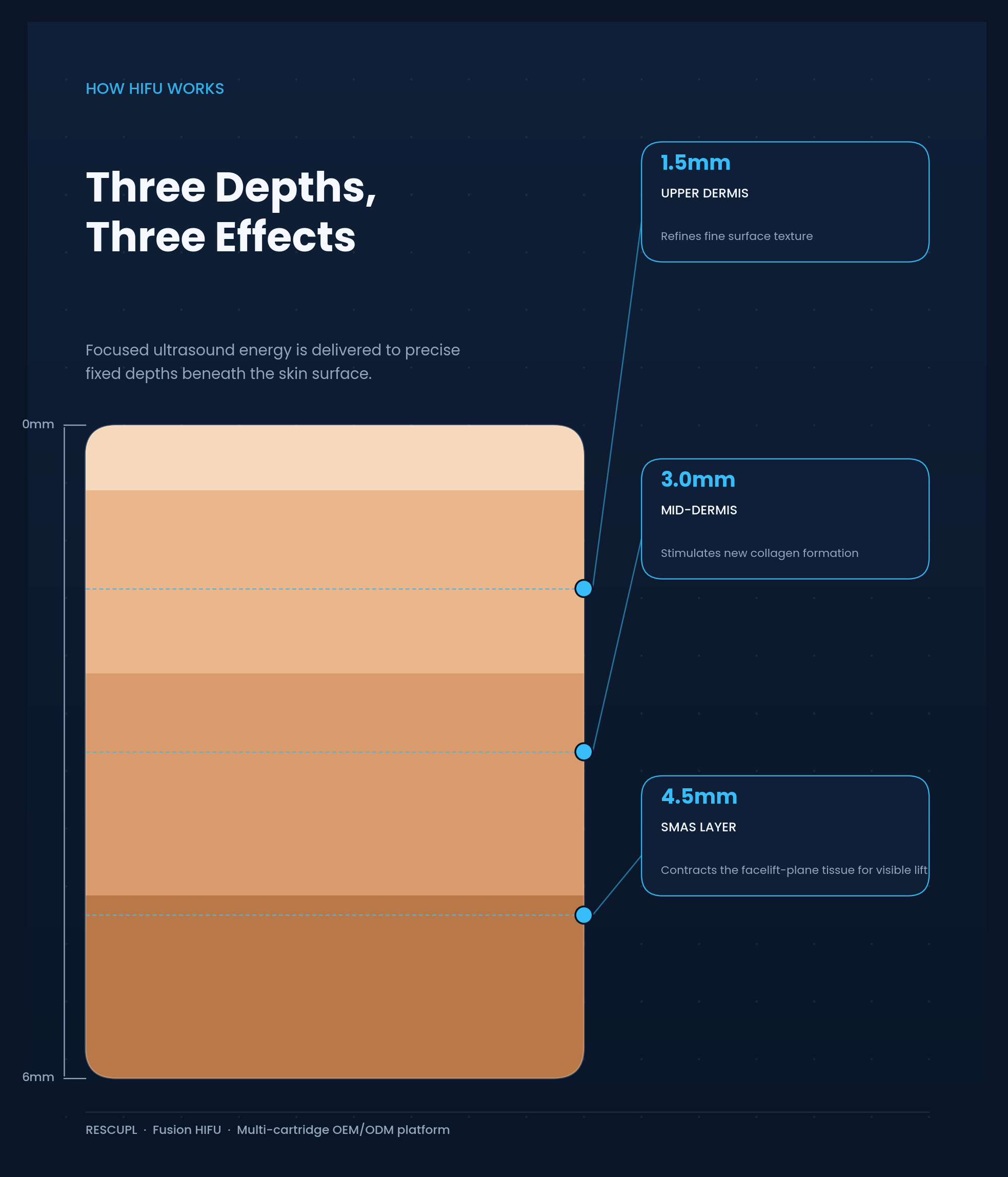 HIFU depth diagram showing 1.5mm, 3.0mm, and 4.5mm treatment layers